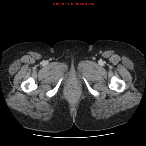 Acute appendicitis complicated by ovarian vein thrombophlebitis (Radiopaedia 16172-15851 Axial C+ portal venous phase 94).jpg