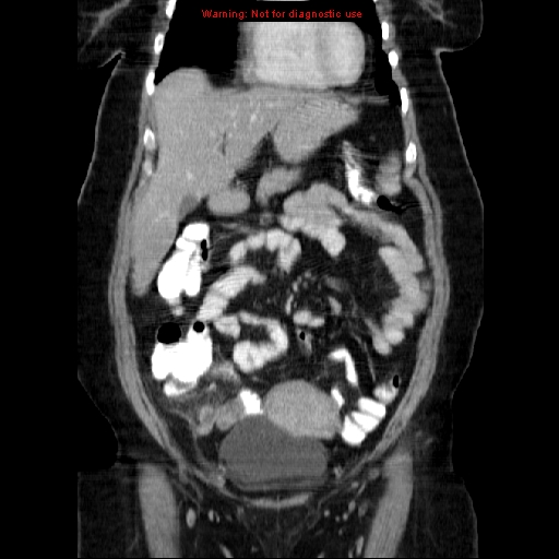 Acute appendicitis complicated by ovarian vein thrombophlebitis (Radiopaedia 16172-15851 Coronal C+ portal venous phase 28).jpg