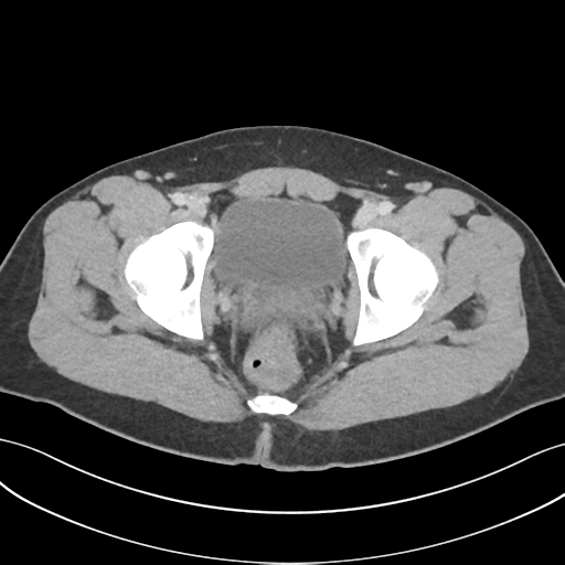 File:Acute appendicitis with appendicoliths (Radiopaedia 50186-55532 Axial C+ portal venous phase 78).png