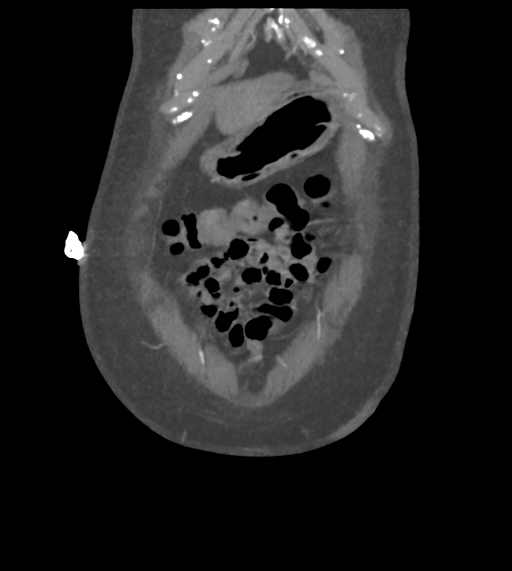 File:Acute bleed from gastric fundus biopsy site (Radiopaedia 35201-36737 Coronal C+ arterial phase 10).png