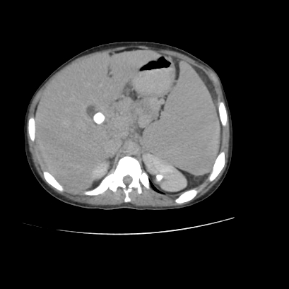 File:Acute calculous cholecystitis in patient with osteopetrosis (Radiopaedia 77871-90159 Axial C+ delayed 8).jpg