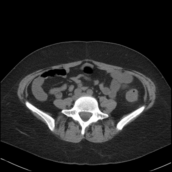 Acute colonic hemorrhage in ulcerative colitis (Radiopaedia 77415-89538 Axial non-contrast 88).jpg