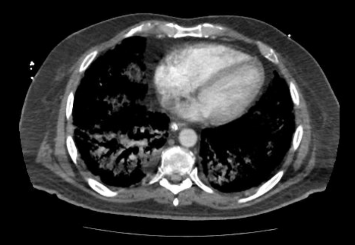 Acute cor pulmonale (ultrasound) (Radiopaedia 83508-98818 Axial C+ CTPA 55).jpg