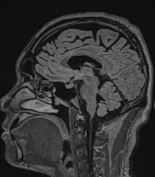 Acute disseminated encephalomyelitis (ADEM)- Anti-NMDA receptor encephalitis (Radiopaedia 54920-61201 Sagittal FLAIR 42).png
