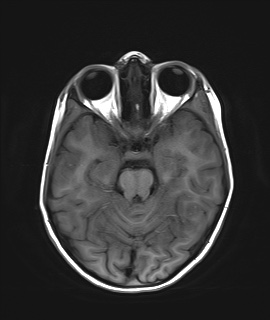 File:Acute disseminating encephalomyelitis with bilateral optic neuritis (Radiopaedia 79676-92886 Axial T1 9).jpg