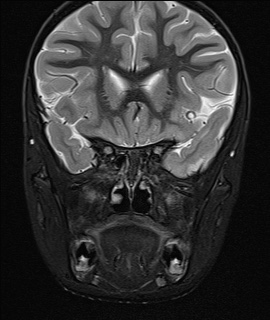File:Acute disseminating encephalomyelitis with bilateral optic neuritis (Radiopaedia 79676-92886 Coronal STIR 12).jpg