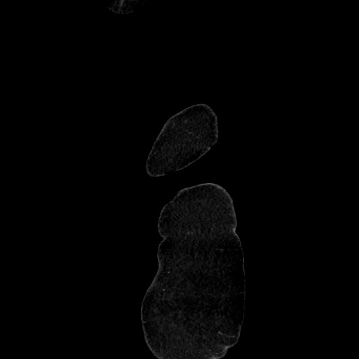 Acute diverticulitis - transverse colon (Radiopaedia 87063-103327 Sagittal C+ portal venous phase 13).jpg
