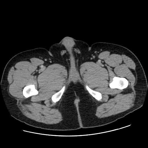Acute diverticulitis with localized perforation (Radiopaedia 41296-44113 Axial C+ portal venous phase 101).jpg