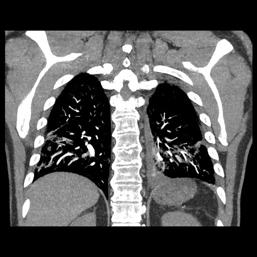 Acute epicardial fat necrosis (Radiopaedia 42327-45440 Coronal C+ CTPA 73).jpg