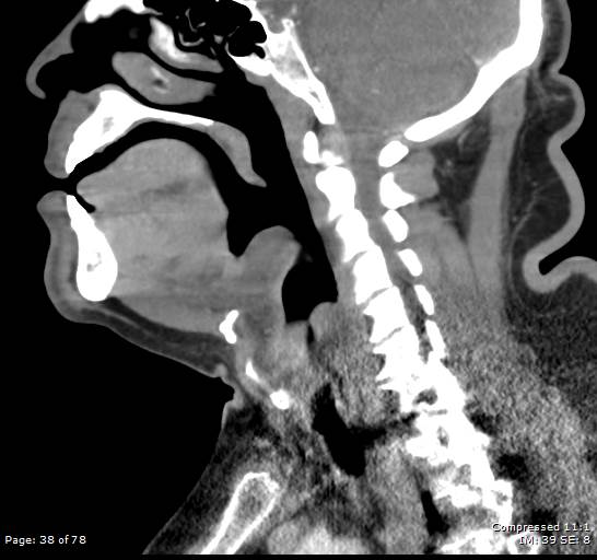 Acute epiglottitis (Radiopaedia 54375-60590 Sagittal C+ arterial phase 38).jpg