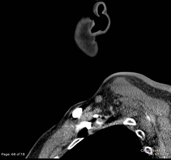 Acute epiglottitis (Radiopaedia 54375-60590 Sagittal C+ arterial phase 68).jpg