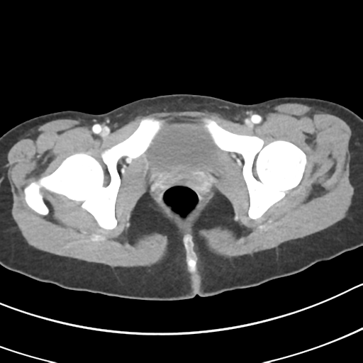 Acute gangrenous appendicitis with perforation (Radiopaedia 40152-42662 Axial C+ portal venous phase 74).png