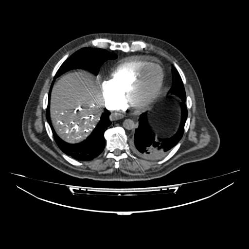 File:Acute heart failure (CT) (Radiopaedia 79835-93075 Axial C+ arterial phase 47).jpg