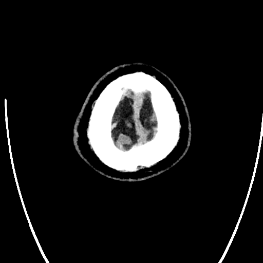 Acute left middle cerebral artery territory ischemic stroke (Radiopaedia 35688-37223 Axial non-contrast 86).png