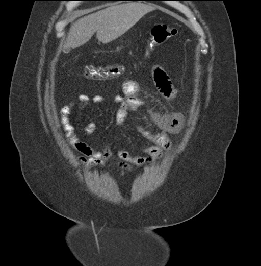 Acute mesenteric venous ischemia (Radiopaedia 46041-50383 Coronal C+ portal venous phase 20).jpg