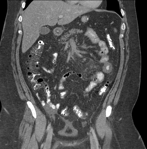 Acute mesenteric venous ischemia (Radiopaedia 46041-50383 Coronal C+ portal venous phase 39).jpg