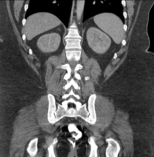Acute mesenteric venous ischemia (Radiopaedia 46041-50383 Coronal C+ portal venous phase 71).jpg
