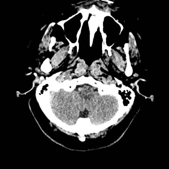 Acute middle cerebral artery territory infarct (Radiopaedia 52380-58283 Axial non-contrast 8).jpg