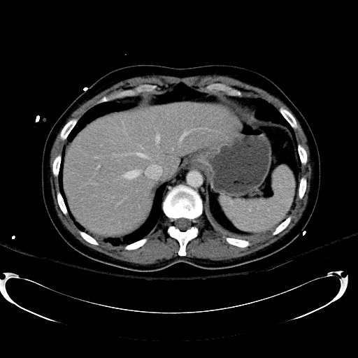 Acute myocardial infarction in CT (Radiopaedia 39947-42415 Axial C+ portal venous phase 23).jpg