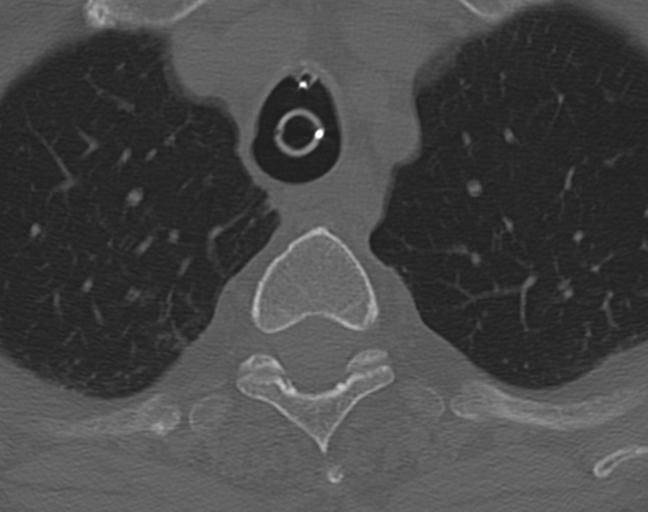 Acute on chronic subdural hematoma and thoracic vertebral injury in a multitrauma patient (Radiopaedia 31698-32619 Axial bone window 68).jpg