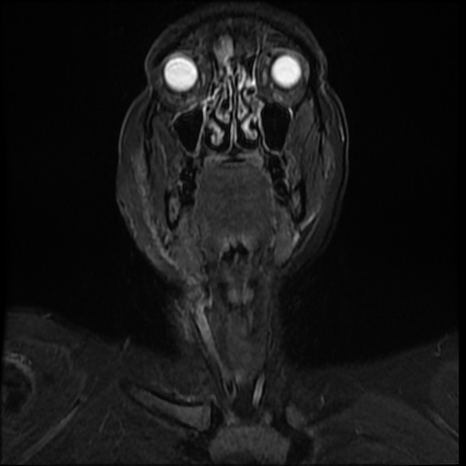 File:Acute otitis externa (Radiopaedia 57296-64236 Coronal STIR 3).jpg