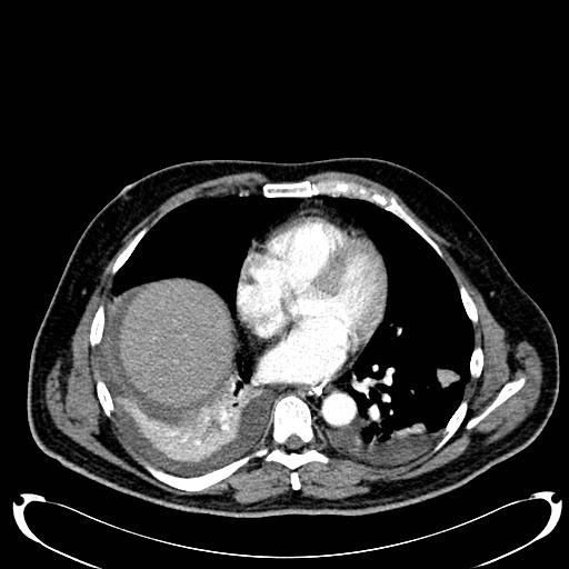 File:Acute pancreatic necrosis (Radiopaedia 13560-18500 Axial C+ portal venous phase 8).jpg