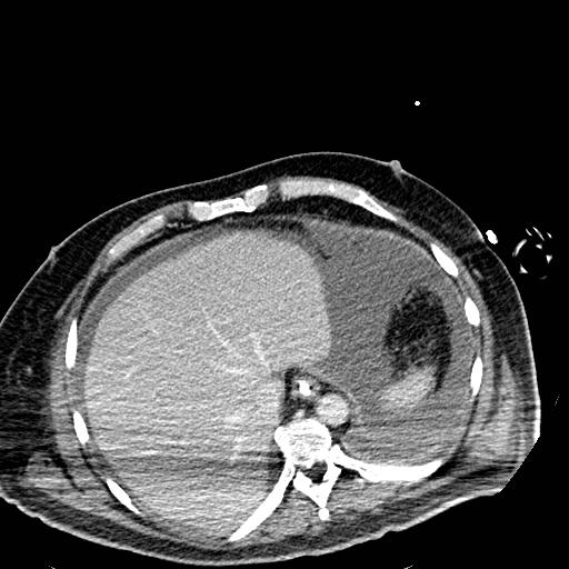 Acute pancreatic necrosis (Radiopaedia 13560-18501 Axial C+ portal venous phase 12).jpg