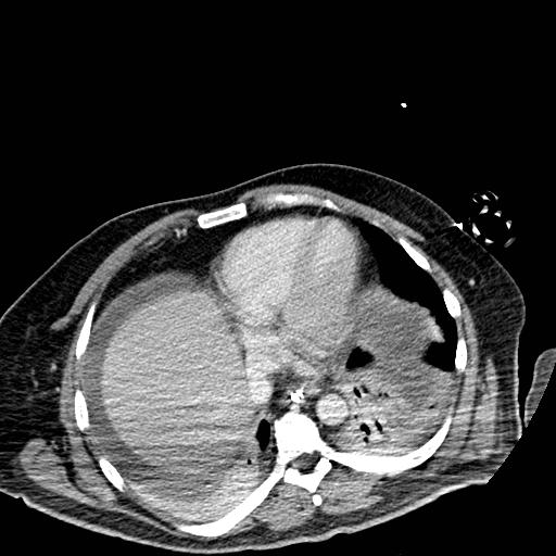 Acute pancreatic necrosis (Radiopaedia 13560-18501 Axial C+ portal venous phase 2).jpg