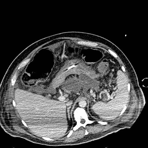 File:Acute pancreatic necrosis (Radiopaedia 13560-18501 Axial C+ portal venous phase 34).jpg