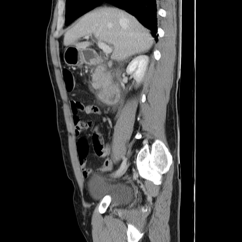 Acute pancreatitis (Radiopaedia 22572-22596 Sagittal C+ portal venous phase 20).jpg
