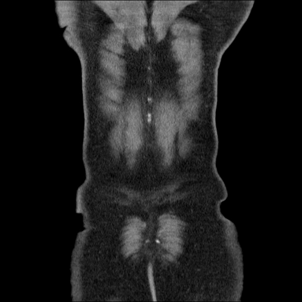 Acute pancreatitis (Radiopaedia 26663-26813 Coronal C+ portal venous phase 61).jpg