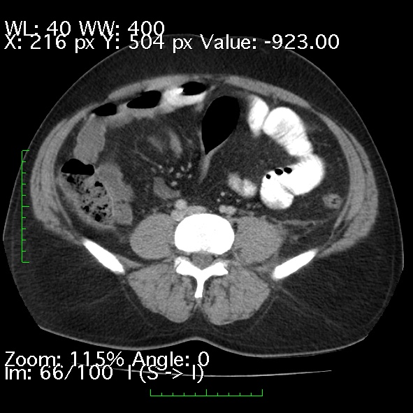 File:Acute pancreatitis (Radiopaedia 34043-35276 Axial C+ portal venous phase 66).jpg