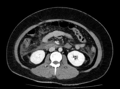 Acute pancreatitis (Radiopaedia 69236-79012 Axial C+ portal venous phase 45).jpg