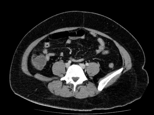 Acute pancreatitis (Radiopaedia 69236-79012 Axial C+ portal venous phase 62).jpg