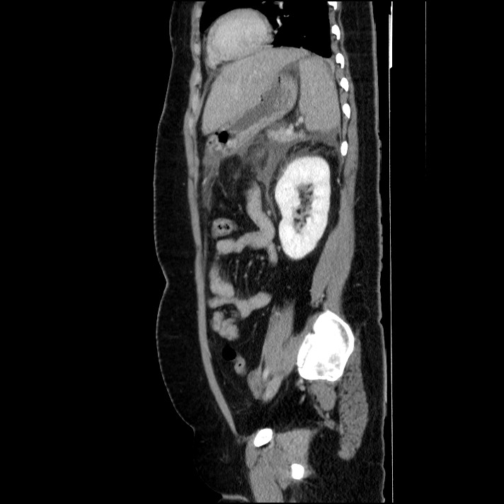 Acute pancreatitis (Radiopaedia 69236-79012 Sagittal C+ portal venous phase 37).jpg