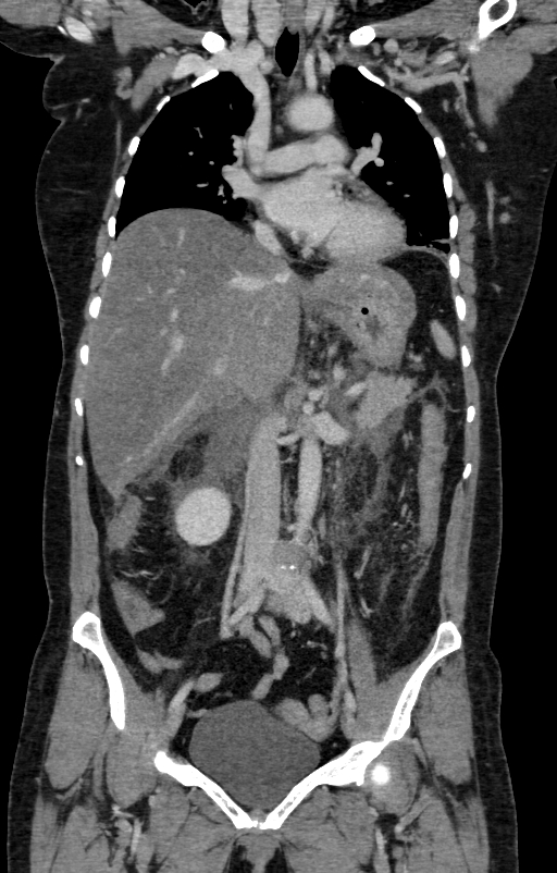 Acute pancreatitis (Radiopaedia 80007-93285 Coronal C+ portal venous phase 55).jpg