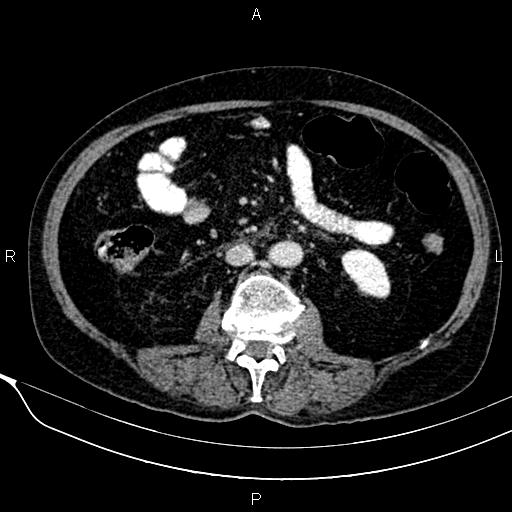Acute pancreatitis (Radiopaedia 85146-100701 Axial C+ portal venous phase 35).jpg