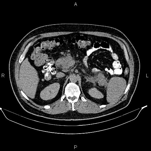 Acute pancreatitis (Radiopaedia 85390-101010 Axial C+ delayed 25).jpg