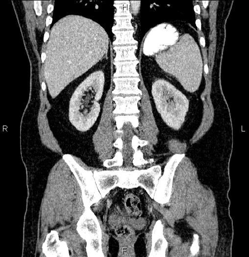 File:Acute pancreatitis (Radiopaedia 85390-101010 Coronal C+ portal venous phase 52).jpg