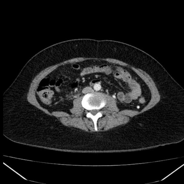 Acute pancreatitis - Balthazar C (Radiopaedia 26569-26714 Axial C+ arterial phase 52).jpg