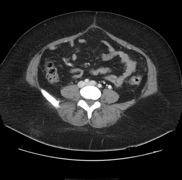Acute pancreatitis - Balthazar E (Radiopaedia 29016-29377 Axial C+ portal venous phase 46).png