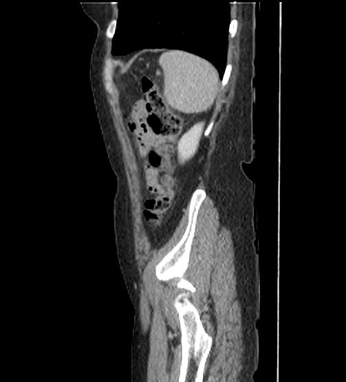 File:Acute pancreatitis - Balthazar E - post ERCP (Radiopaedia 27562-27772 Sagittal C+ portal venous phase 116).png