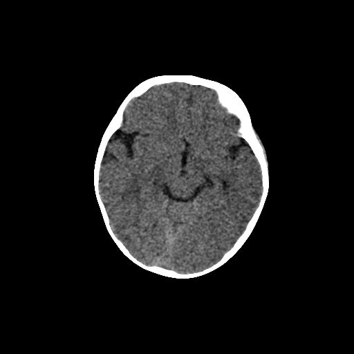 Acute phase of hemiconvulsion-hemiplegia epilepsy syndrome (Radiopaedia 29309-29744 Axial non-contrast 31).jpg