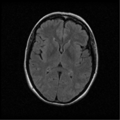 File:Acute pontine infarct from vertebral artery dissection (Radiopaedia 34111-35370 Axial FLAIR 11).png