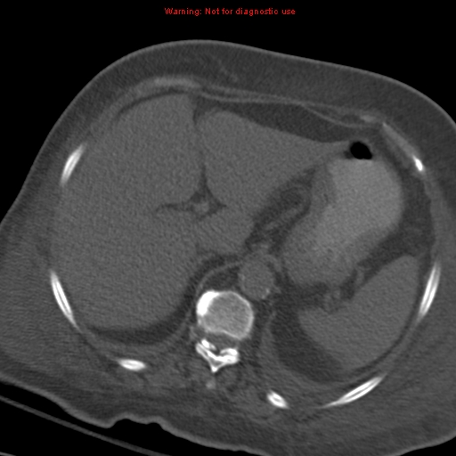 Acute pulmonary embolism (Radiopaedia 13286-13289 Axial C+ CTPA 66).jpg