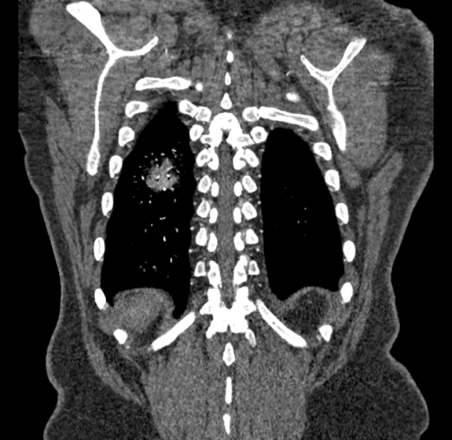 Acute pulmonary embolism with pulmonary infarcts (Radiopaedia 77688-89908 Coronal C+ CTPA 94).jpg
