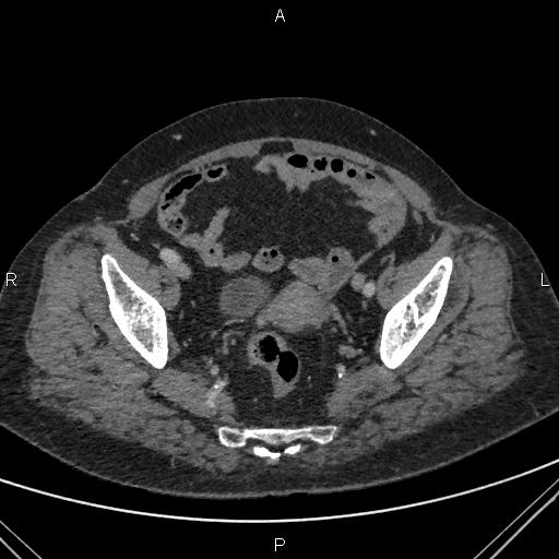 File:Acute renal artery occlusion (Radiopaedia 86586-102682 Axial C+ portal venous phase 84).jpg