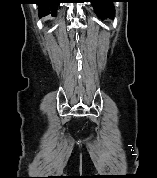 Acute renal infarction (Radiopaedia 59375-66736 Coronal C+ portal venous phase 56).jpg