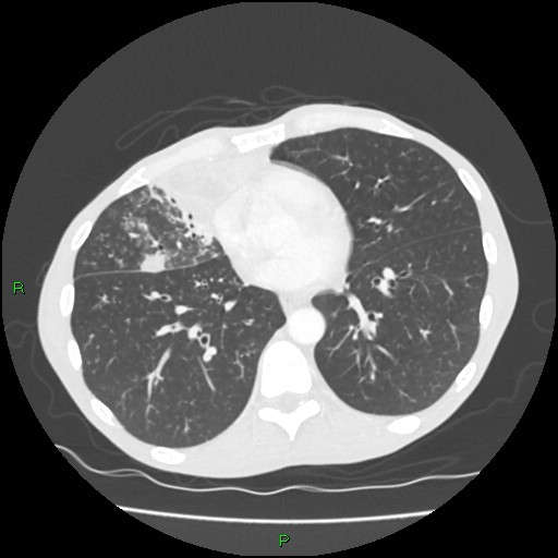 Acute right lung abscess (Radiopaedia 34806-36258 Axial lung window 119).jpg