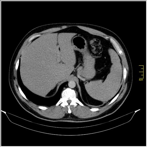 File:Acute right sided diverticulitis (Radiopaedia 65249-74268 Axial C+ portal venous phase 14).JPG